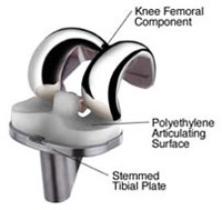 Knee Replacement at KG Hospitals India