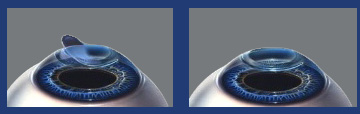 Lasik Procedure Steps 78